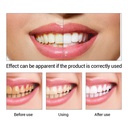 Blanchiment Des Dents LANBENA