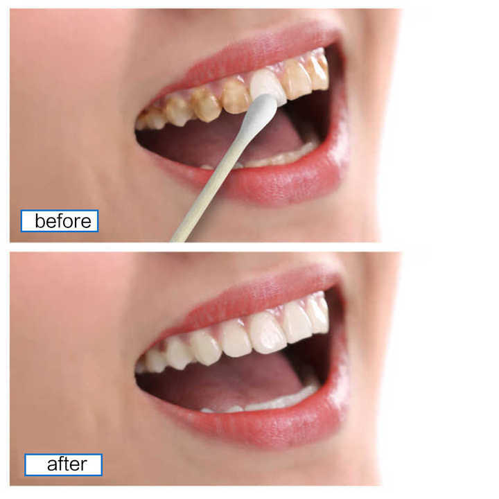 Blanchiment Des Dents LANBENA
