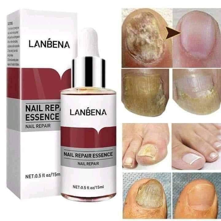 Lanbena Sérum Essence traitement antifongique enlève les champignons ongles réparateur Piedsmains