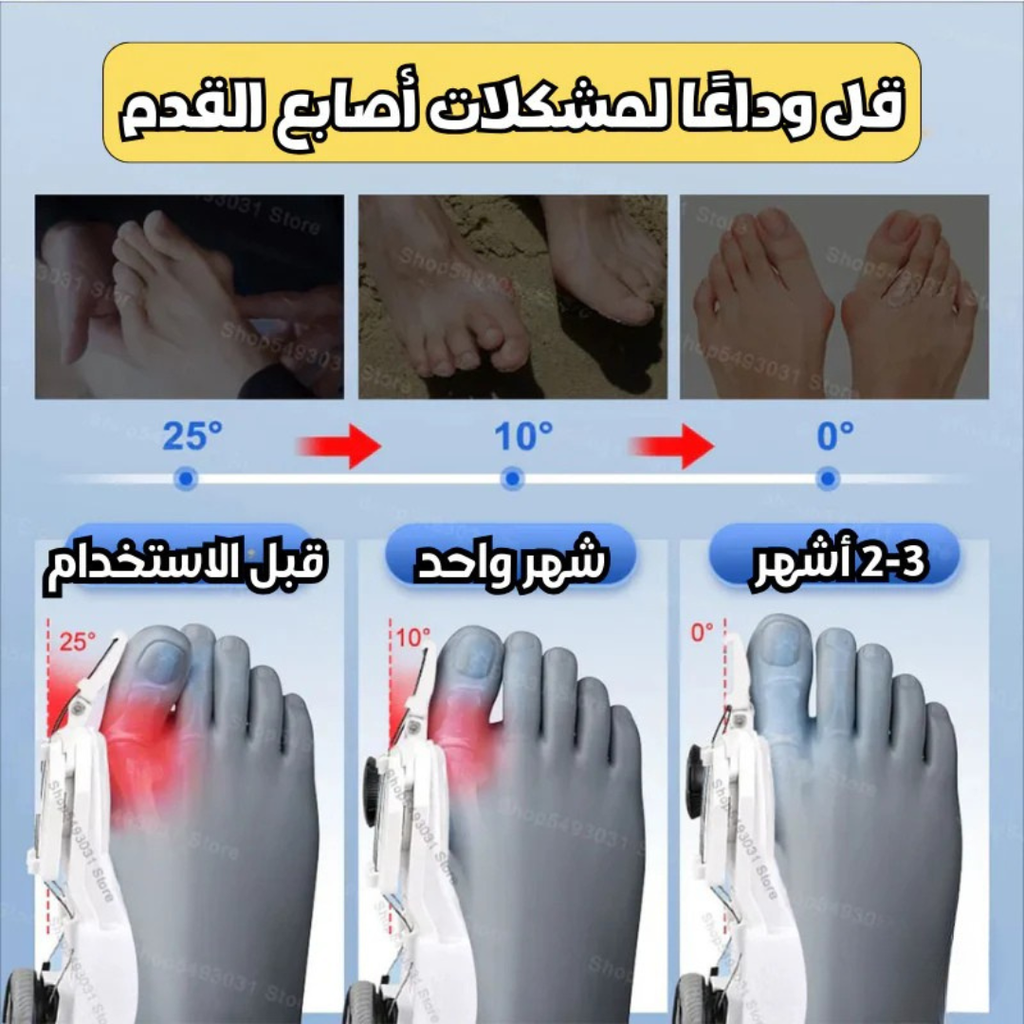 Correcteur Hallux avec Molette Réglable